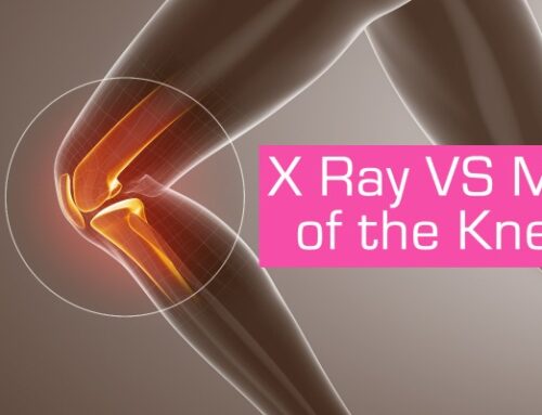 X-Ray vs MRI of the Knee
